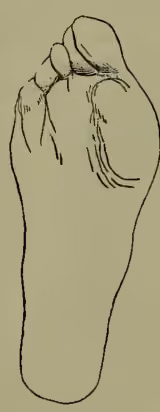 Diagram of the sole of a foot distorted by a shoe, showing the great toe axis curved and the toes overlapping.