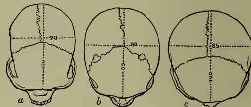 Figure 5 shows three diagrams of human skulls from the vertex (top-down) view, labeled a, b, and c. Diagram a (Negro) shows a wide skull with a cranial index of 70. Diagram b (European) shows a medium-width skull with a cranial index of 80. Diagram c (Samoyed) shows a narrow skull with a cranial index of 85. Each diagram includes a horizontal dashed line across the braincase and a vertical dashed line from the top to the base, with '100' marked on the vertical line to indicate the measurement scale.